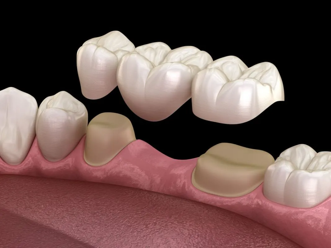 Dental Implants vs. Bridges: Which Is Right for You?