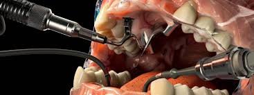 How Dentists Treat Oral Abscesses