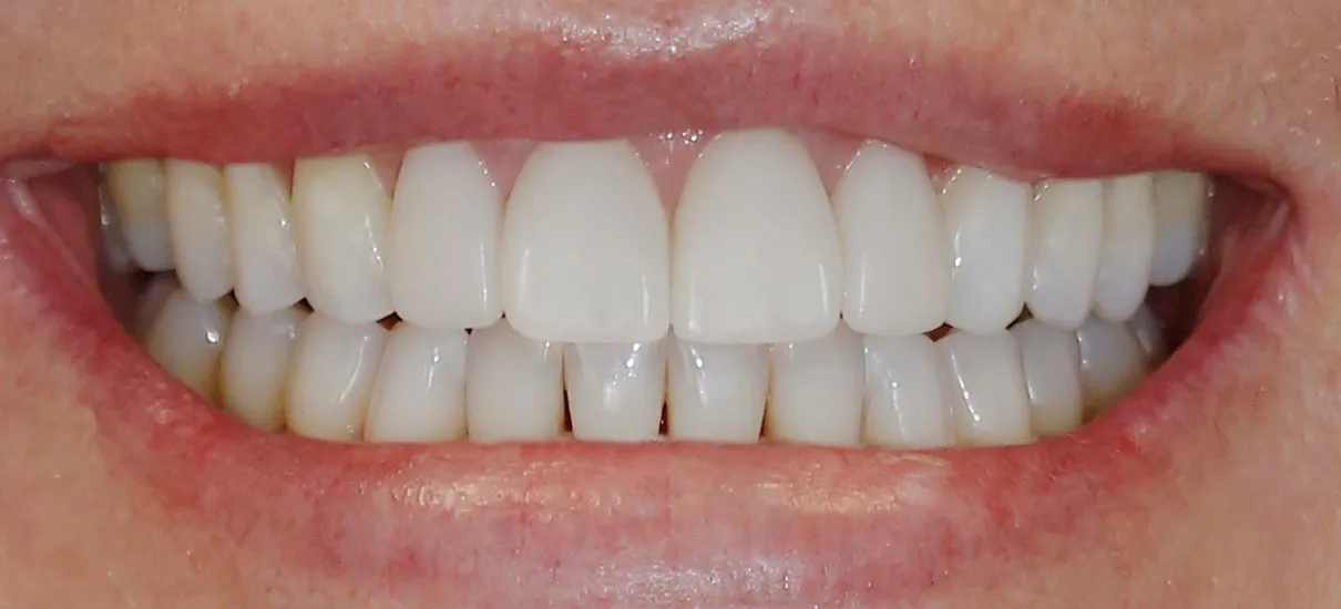 The Process of Getting Veneers