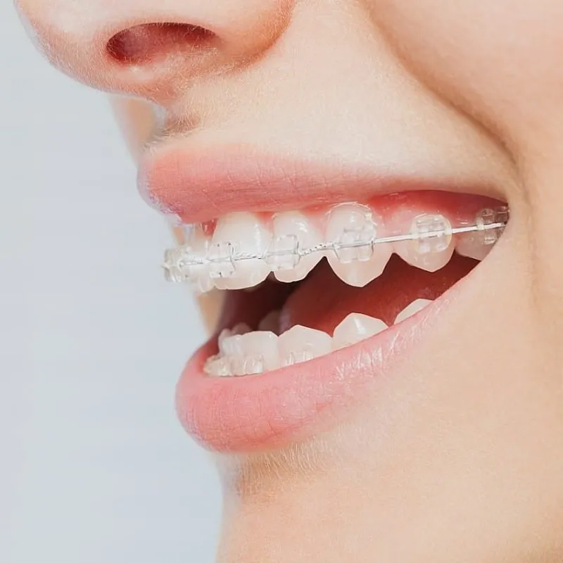 The Pros and Cons of Choosing Invisalign Over Traditional Braces
