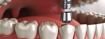 Understanding the Role of an Implant Specialist in Full-Mouth Rehabilitation