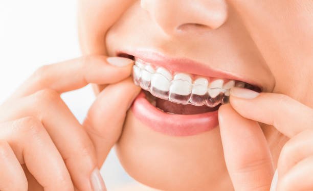 What You Should Know About Clear Aligners for Teeth Straightening