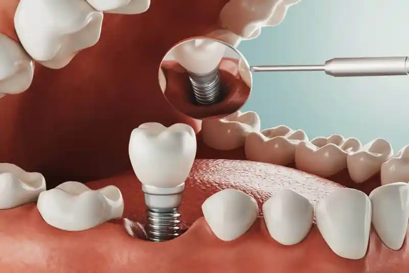 4 Benefits of Getting Dental Implants