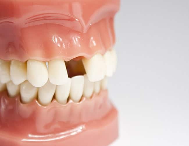 Effective Ways to Restore Function After Tooth Loss