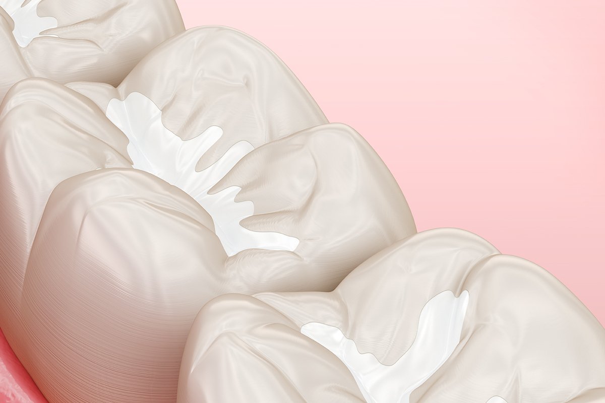 How Sealants Protect Teeth from Decay
