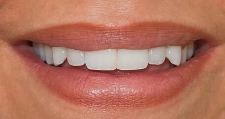 How Veneers Can Transform Your Smile