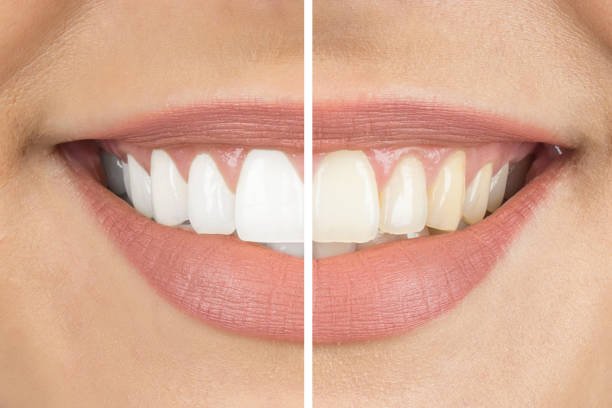 The Best Teeth Whitening Solutions for Summer Smiles