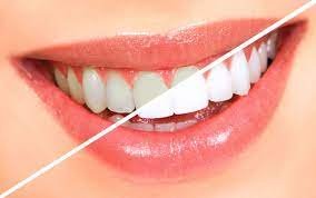 The Different Types of Teeth Whitening Treatments: Which One Is Right for You?