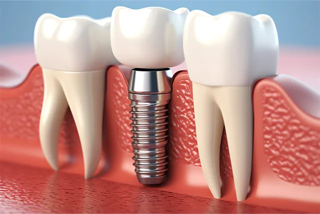 Why Dental Implants Are the Best Option for Tooth Replacement