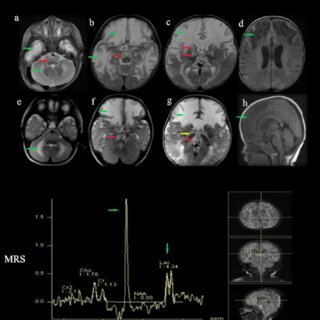 Advancements in Pediatric Neurology
