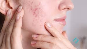 Acne Treatment Options and Finding the Right Solution for You