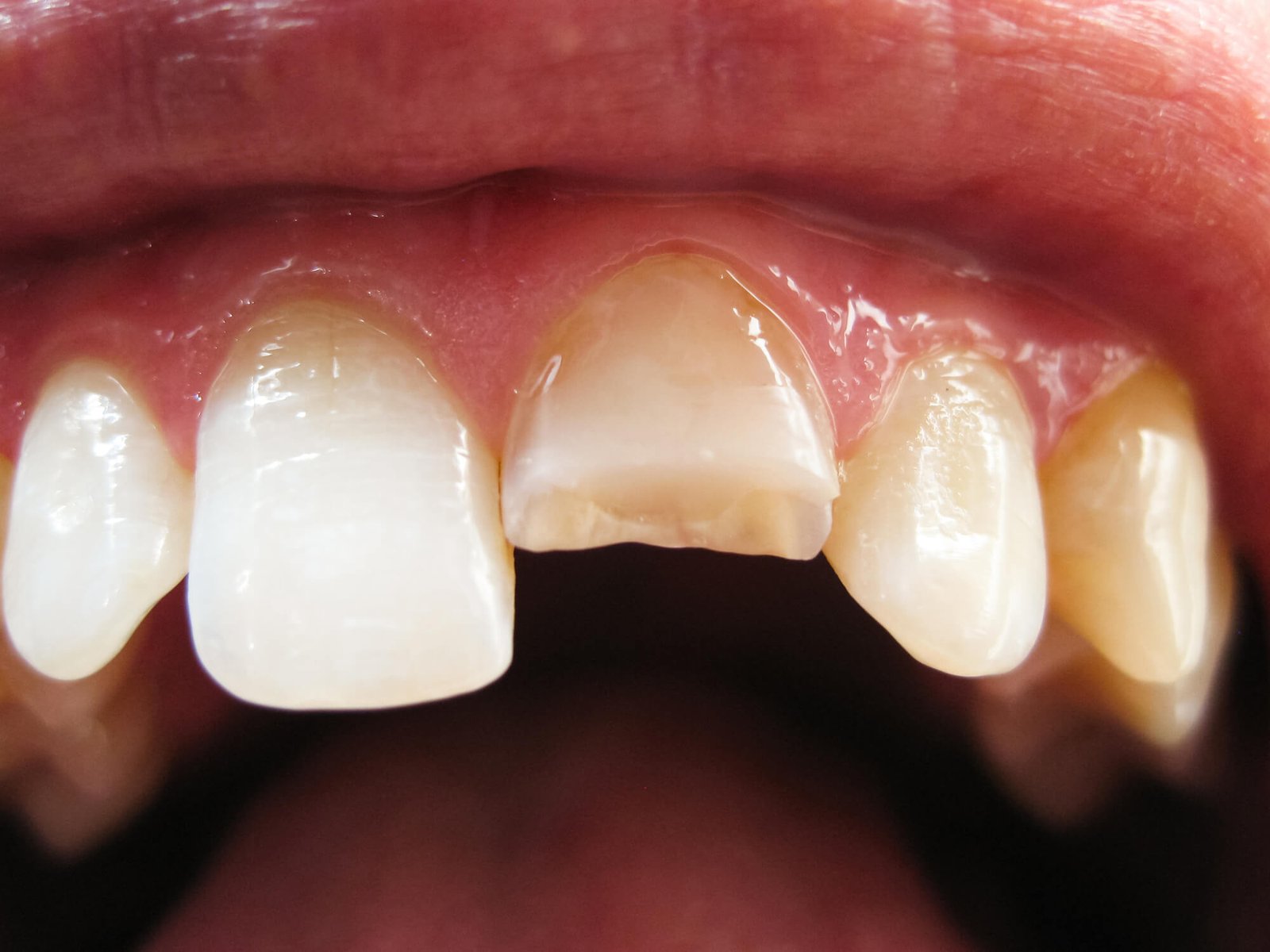 Common Symptoms and Treatment for Cracked Teeth