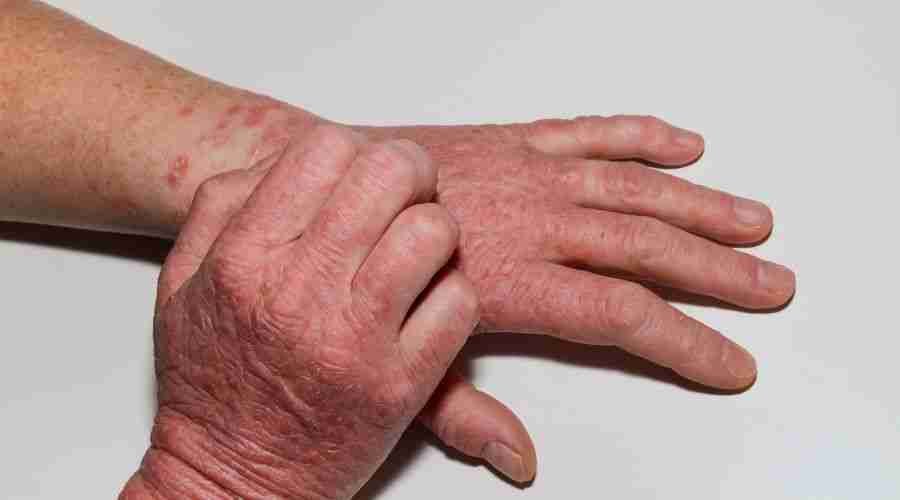 Effective Eczema Treatment Options