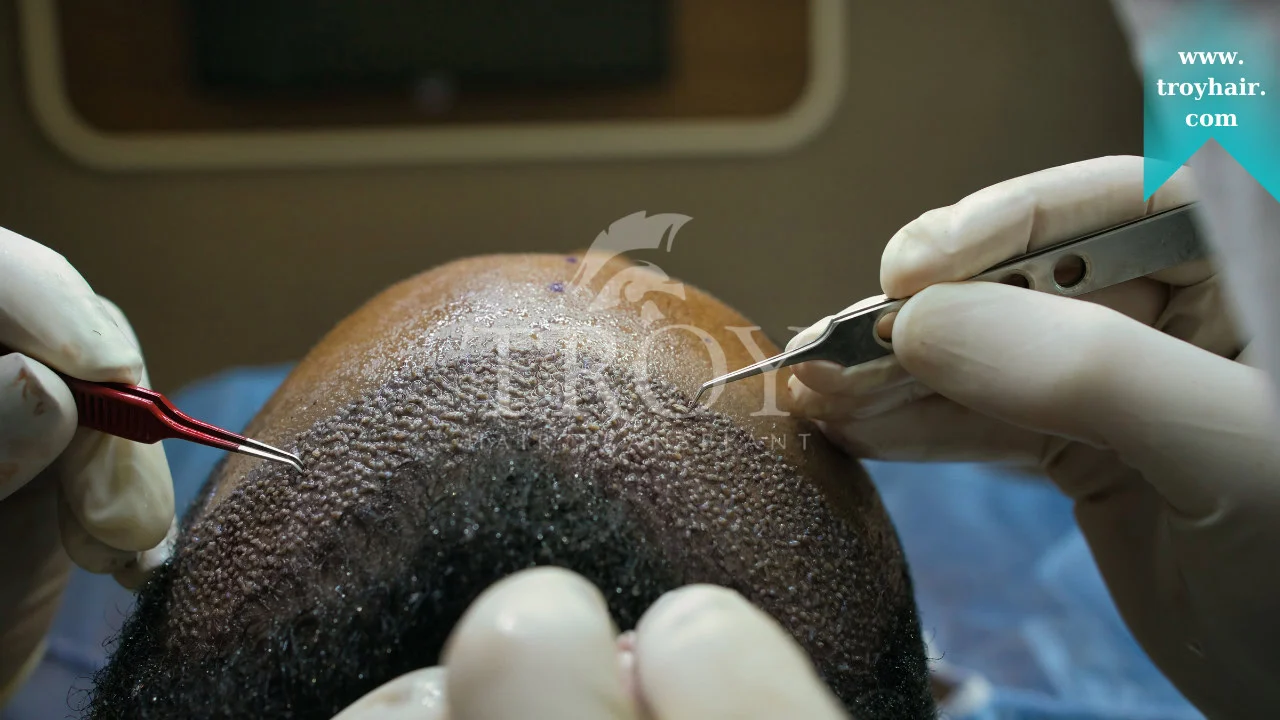 How Lifestyle Choices Can Affect Hair Transplant Outcomes