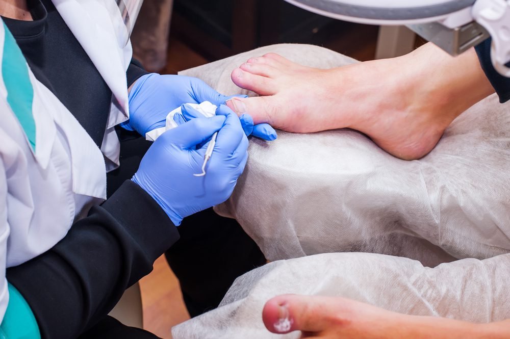 How To Prevent and Treat Ingrown Toenails Effectively