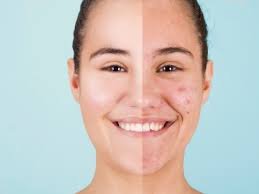 Lifestyle Changes To Help Reduce Acne Breakouts