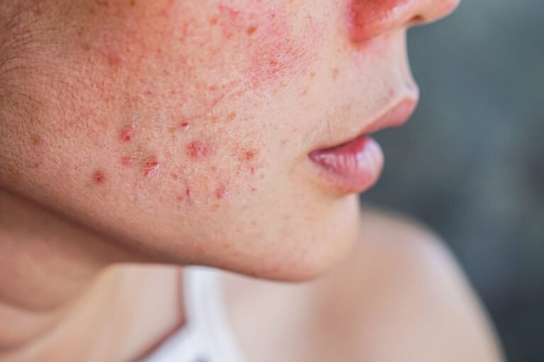 Questions To Ask Your Dermatologist About Acne