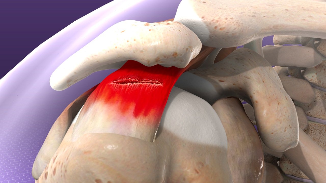 Recognizing the Signs of a Rotator Cuff Tear and When to Seek Help