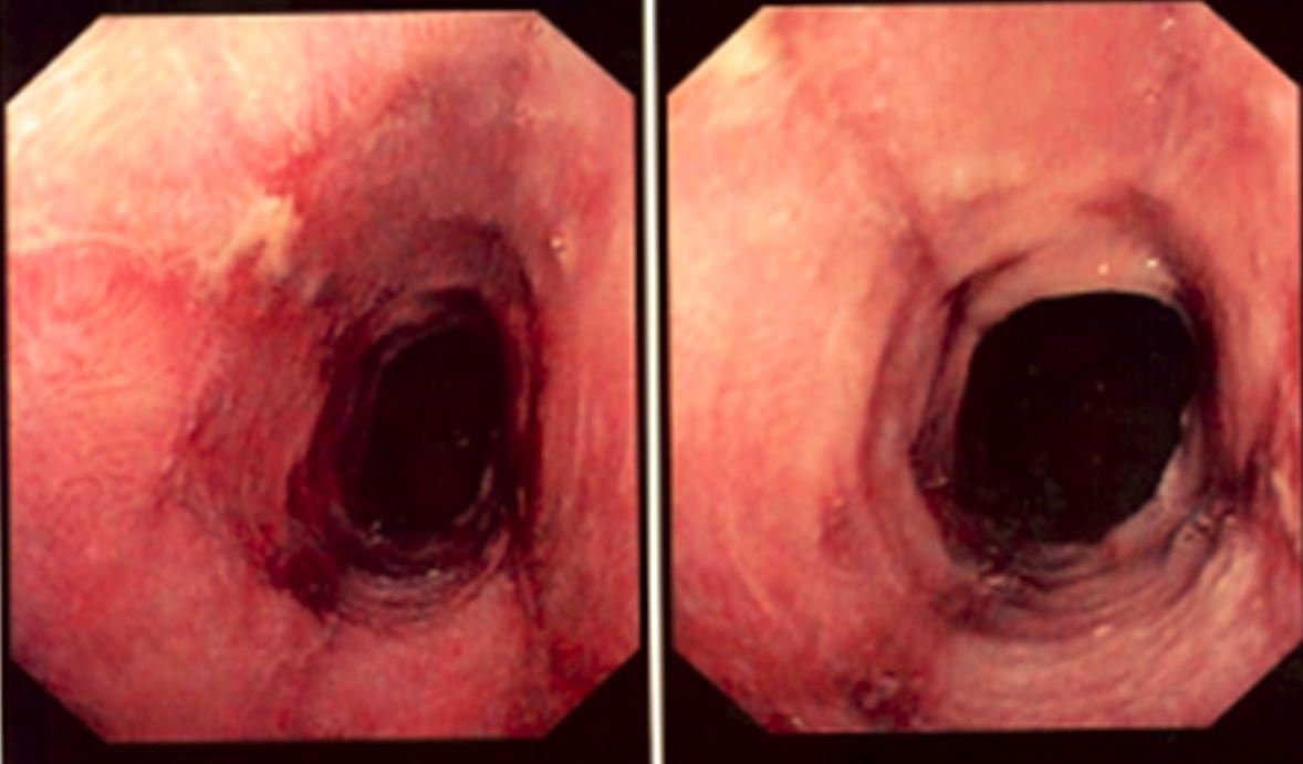 The Benefits of Early Detection Through Endoscopy