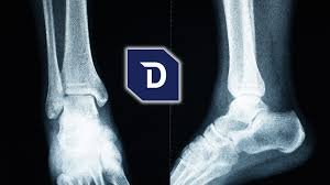 Who Is a Good Candidate for Ankle Replacement?