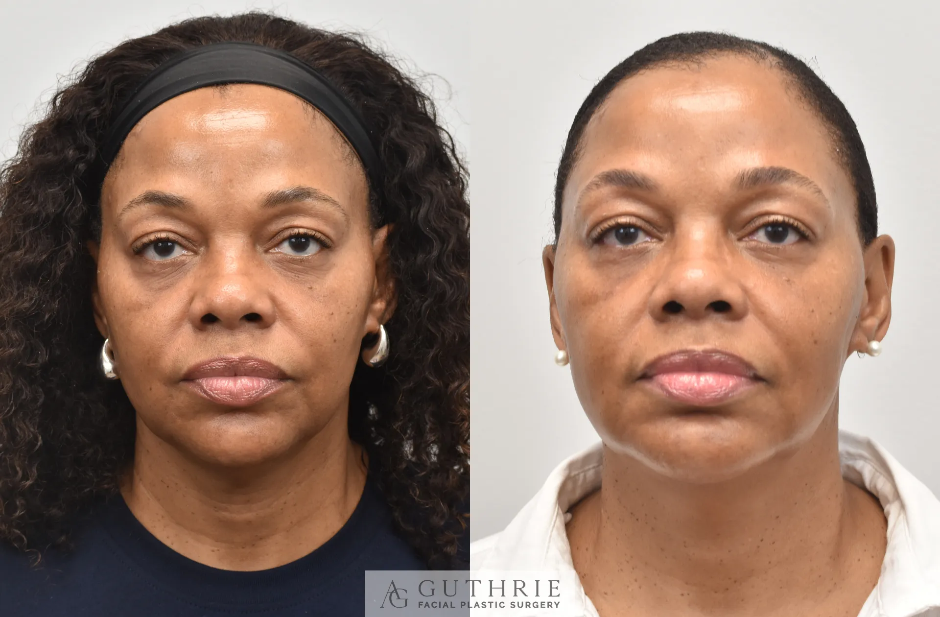 How a Face Lift Can Enhance Facial Harmony