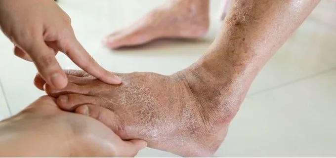 Identifying Common Symptoms of Leg Pain Related to Circulation