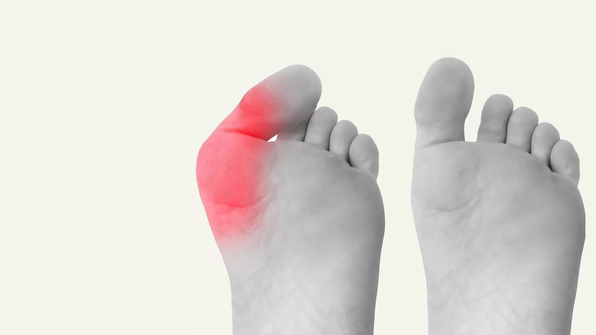 Understanding the Different Types of Bunion Surgery