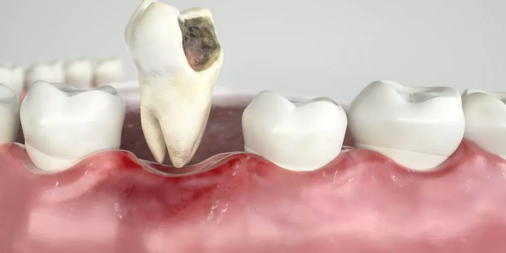 What To Expect After A Tooth Extraction