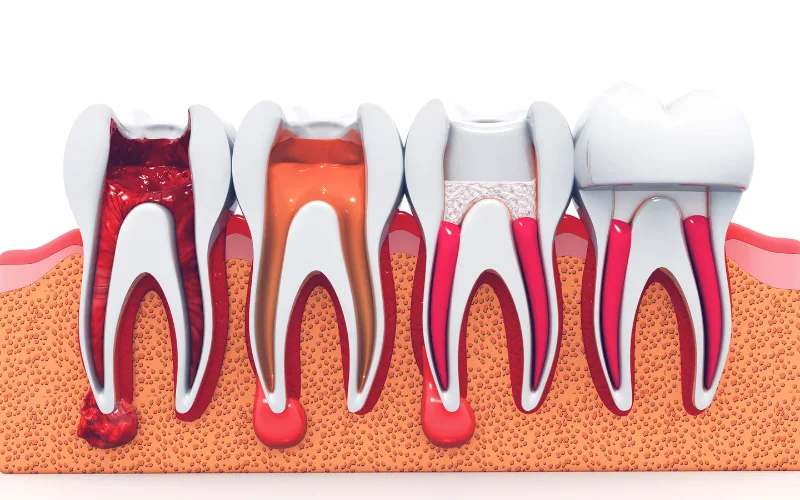 When Do You Need a Root Canal Treatment?