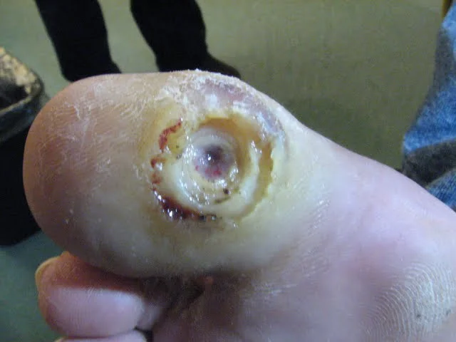 Wound Care for Pressure Ulcers